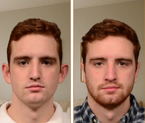 6 Earlo - Ear Correction Patch