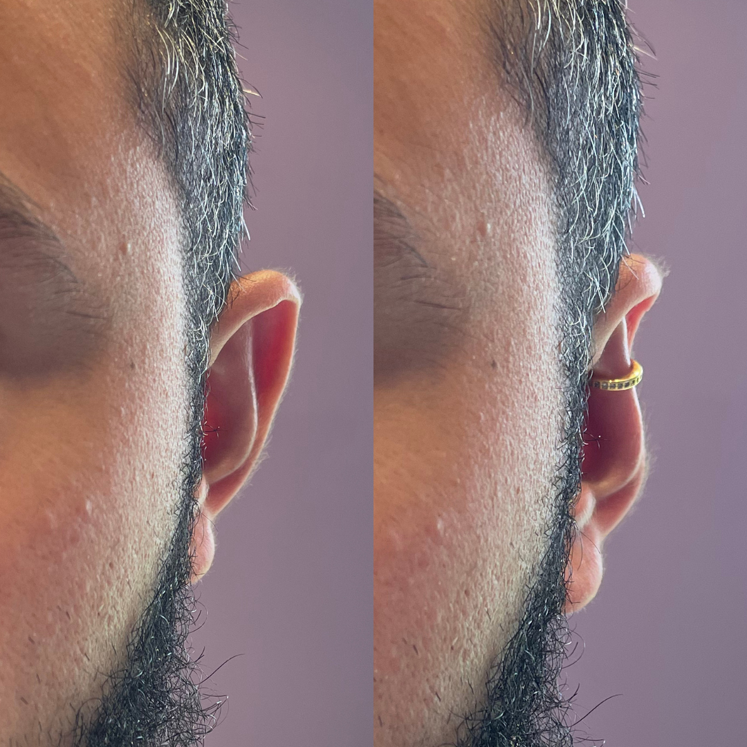 Aurix 925 Plata - Corrección Estética de Orejas sin Cirugía
