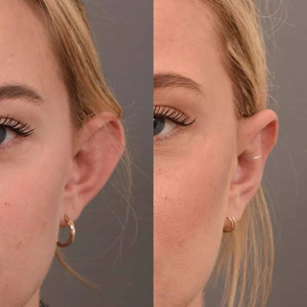 Set Aurix – Ear Corrector Clip