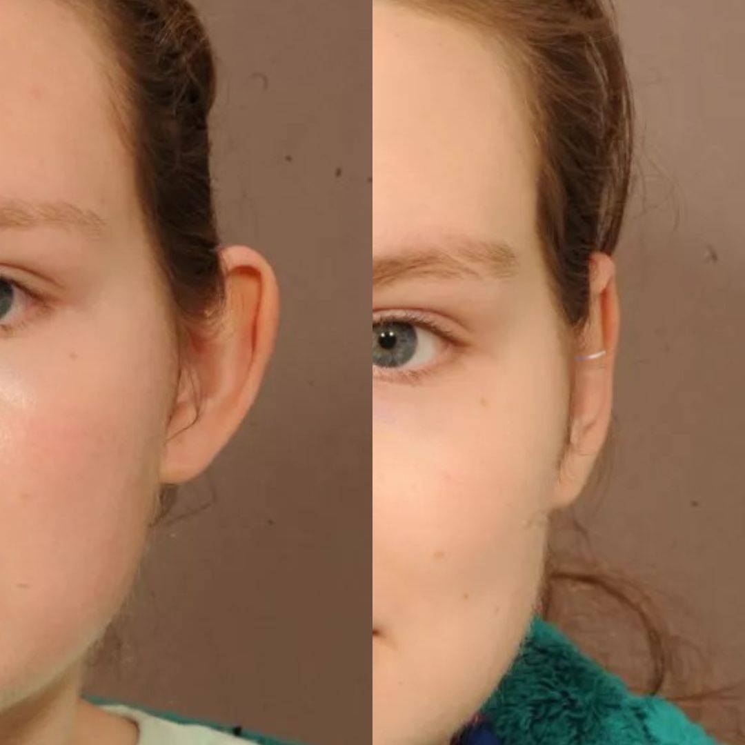 Set Aurix – Ear Corrector Clip