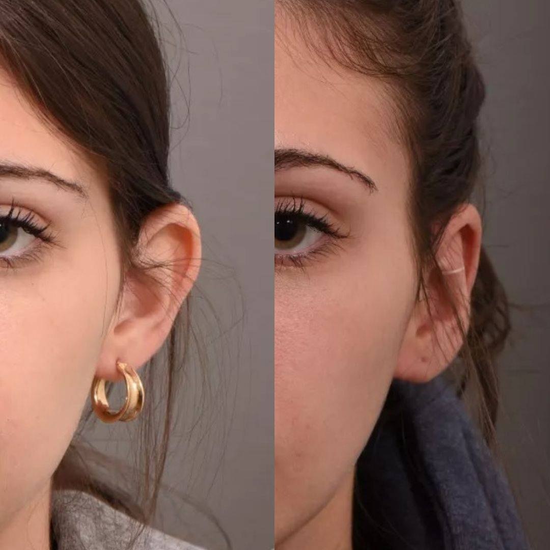 Set Aurix – Ear Corrector Clip