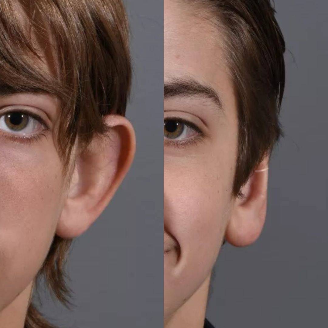 Set Aurix – Ear Corrector Clip