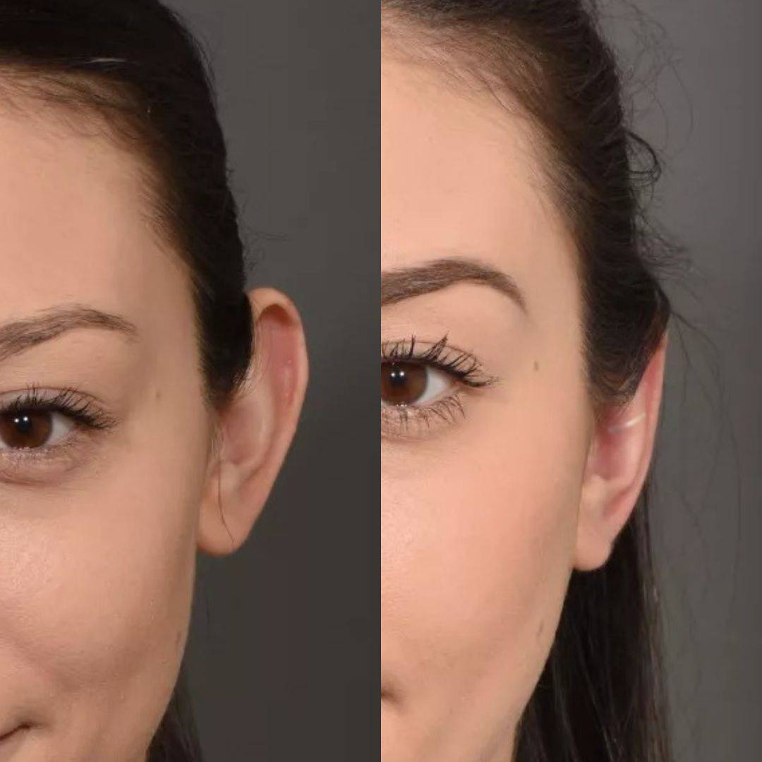 Set Aurix – Ear Corrector Clip