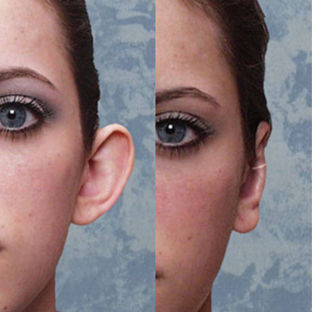 Set Aurix – Ear Corrector Clip