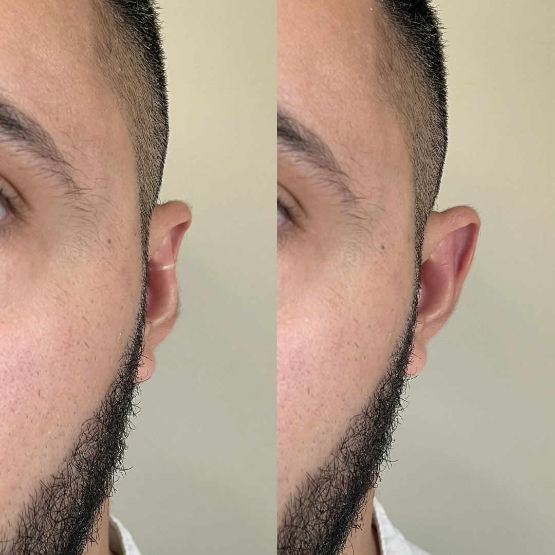 Set Aurix – Ear Corrector Clip